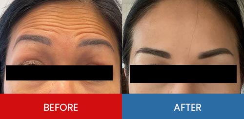 Before & After - Island Medical and Beauty Clinic in Honolulu, HI Before & After - Island Medical and Beauty Clinic in Honolulu, HI