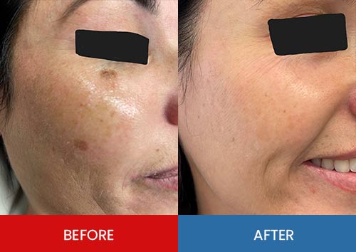 Before & After - Island Medical and Beauty Clinic in Honolulu, HI Before & After - Island Medical and Beauty Clinic in Honolulu, HI