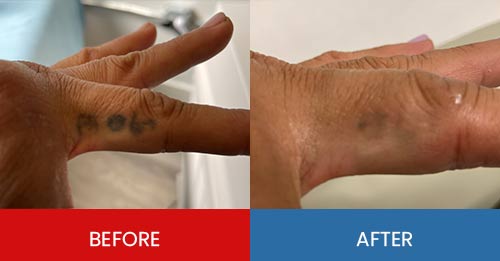 Before & After - Island Medical and Beauty Clinic in Honolulu, HI Before & After - Island Medical and Beauty Clinic in Honolulu, HI