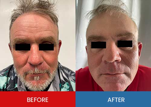 Before & After - Island Medical and Beauty Clinic in Honolulu, HI Before & After - Island Medical and Beauty Clinic in Honolulu, HI