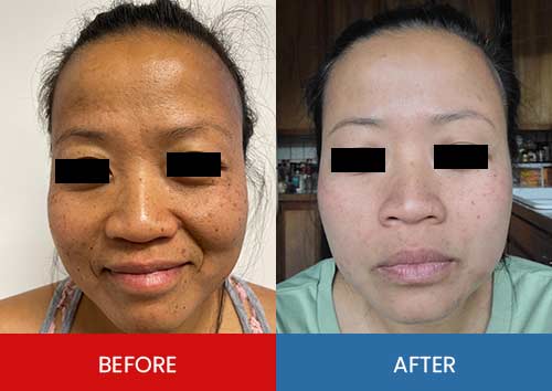Before & After - Island Medical and Beauty Clinic in Honolulu, HI Before & After - Island Medical and Beauty Clinic in Honolulu, HI