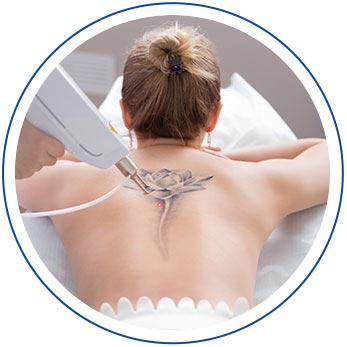 Tattoo Removal - Island Medical and Beauty Clinic in Honolulu, HI