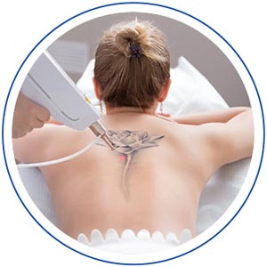 Tattoo Removal - Island Medical and Beauty Clinic in Honolulu, HI