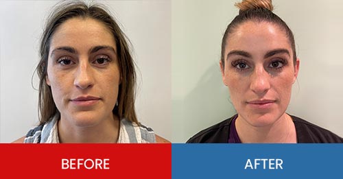 Before & After - Island Medical and Beauty Clinic in Honolulu, HI Before & After - Island Medical and Beauty Clinic in Honolulu, HI
