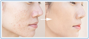 Aerolase Treatment Specialist Near Me in Honolulu, HI Aerolase Treatment Specialist Near Me in Honolulu, HI
