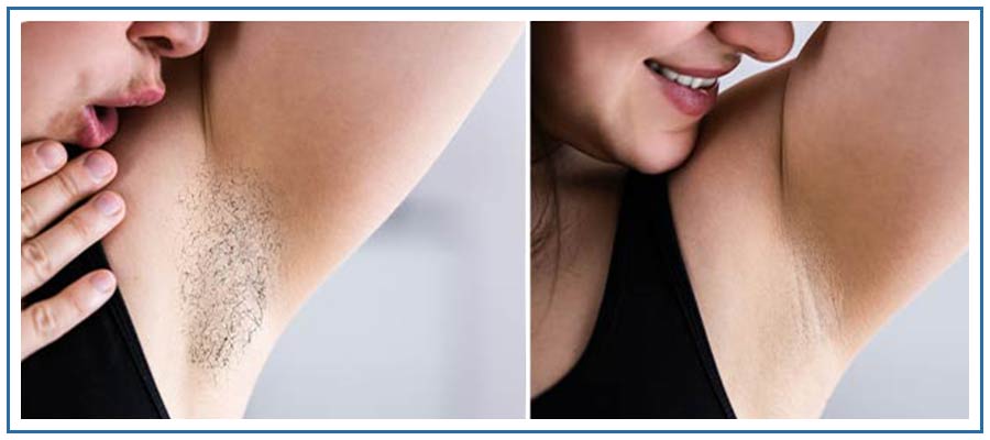 EpiLaze Laser Hair Removal Treatment Near Me in Honolulu, HI EpiLaze Laser Hair Removal Treatment Near Me in Honolulu, HI
