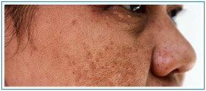 Melasma Treatment Specialist Near Me in Honolulu, HI Melasma Treatment Specialist Near Me in Honolulu, HI