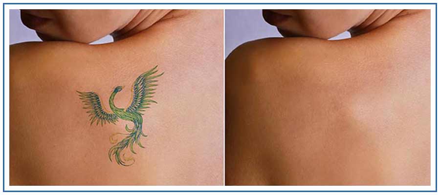 Laser Tattoo Removal Sessions  Rock Star Tattoo Piercing  Laser Tattoo  Removal  Groupon