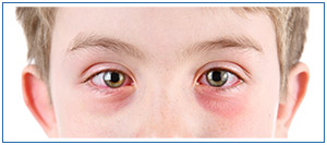 Pink Eye Treatment Specialist Near Me in Honolulu HI Pink Eye Treatment Specialist Near Me in Honolulu HI