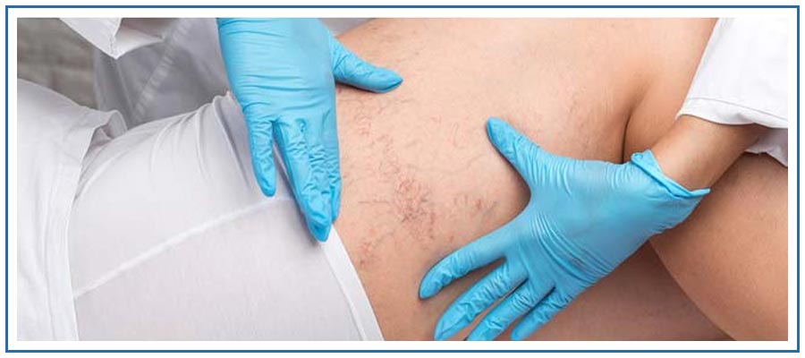 Spider Veins Reduction Treatment Near Me in Honolulu, HI Spider Veins Reduction Treatment Near Me in Honolulu, HI