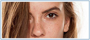 Sun Spots Removal Specialist in Honolulu, HI