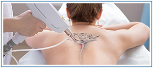 Tattoo Removal Specialist Near Me in Honolulu, HI Tattoo Removal Specialist Near Me in Honolulu, HI