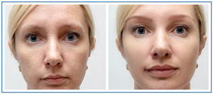 Hollywood Facial Rejuvenation Near Me in Honolulu, HI Hollywood Facial Rejuvenation Near Me in Honolulu, HI