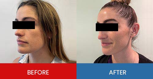 Before & After - Island Medical and Beauty Clinic in Honolulu, HI Before & After - Island Medical and Beauty Clinic in Honolulu, HI