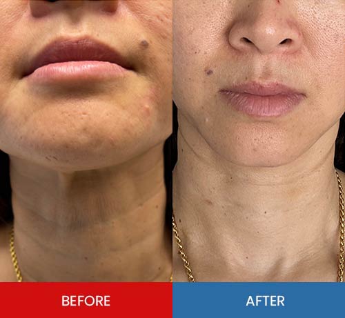 Before & After - Island Medical and Beauty Clinic in Honolulu, HI Before & After - Island Medical and Beauty Clinic in Honolulu, HI