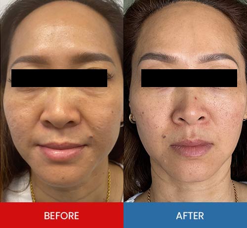 Before & After - Island Medical and Beauty Clinic in Honolulu, HI Before & After - Island Medical and Beauty Clinic in Honolulu, HI