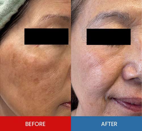 Before & After - Island Medical and Beauty Clinic in Honolulu, HI Before & After - Island Medical and Beauty Clinic in Honolulu, HI