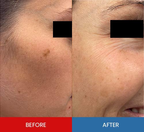 Before & After - Island Medical and Beauty Clinic in Honolulu, HI Before & After - Island Medical and Beauty Clinic in Honolulu, HI