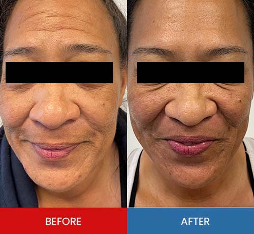 Before & After - Island Medical and Beauty Clinic in Honolulu, HI