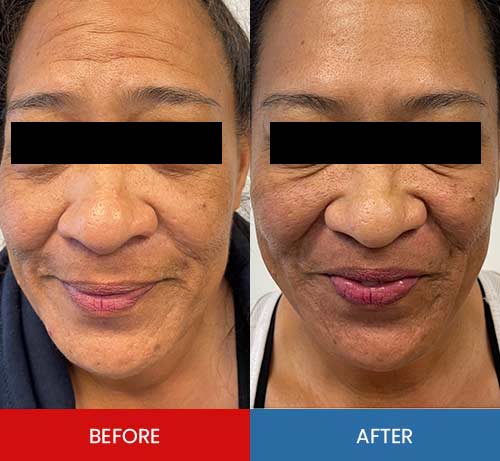 Before & After - Island Medical and Beauty Clinic in Honolulu, HI Before & After - Island Medical and Beauty Clinic in Honolulu, HI