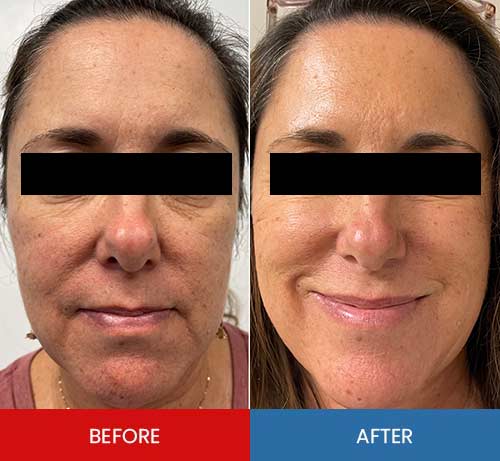 Before & After - Island Medical and Beauty Clinic in Honolulu, HI Before & After - Island Medical and Beauty Clinic in Honolulu, HI
