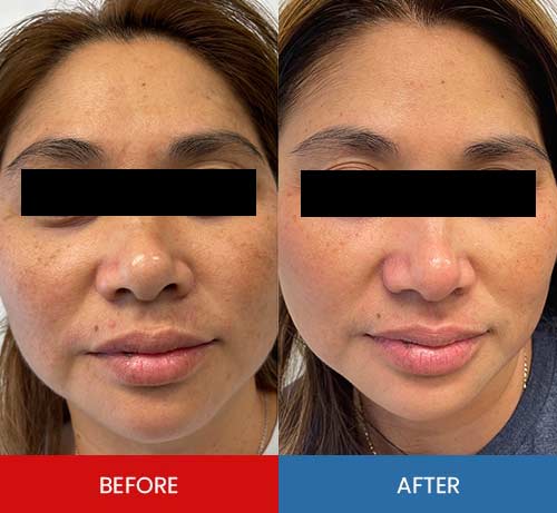 Before & After - Island Medical and Beauty Clinic in Honolulu, HI Before & After - Island Medical and Beauty Clinic in Honolulu, HI