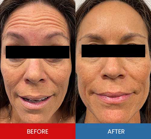 Before & After - Island Medical and Beauty Clinic in Honolulu, HI Before & After - Island Medical and Beauty Clinic in Honolulu, HI