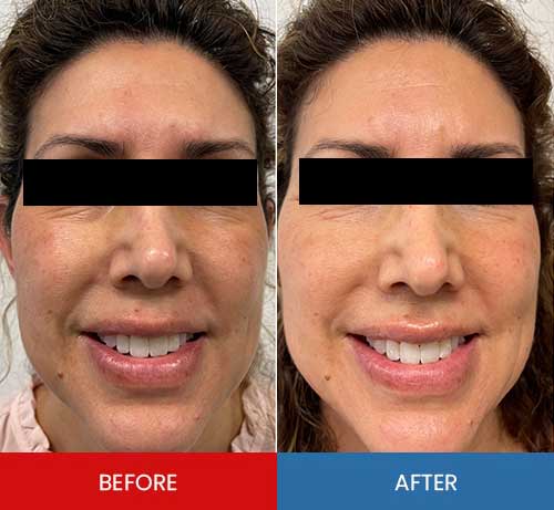 Before & After - Island Medical and Beauty Clinic in Honolulu, HI Before & After - Island Medical and Beauty Clinic in Honolulu, HI