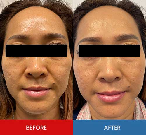 Before & After - Island Medical and Beauty Clinic in Honolulu, HI Before & After - Island Medical and Beauty Clinic in Honolulu, HI