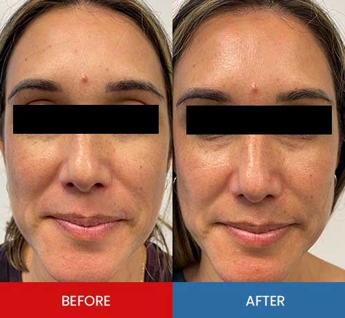 Before & After - Island Medical and Beauty Clinic in Honolulu, HI Before & After - Island Medical and Beauty Clinic in Honolulu, HI