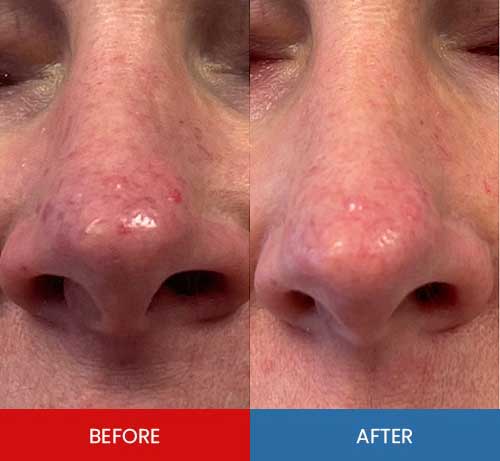 Before & After - Island Medical and Beauty Clinic in Honolulu, HI Before & After - Island Medical and Beauty Clinic in Honolulu, HI