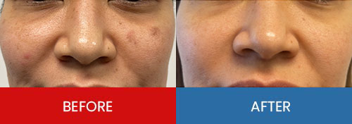 Before & After - Island Medical and Beauty Clinic in Honolulu, HI Before & After - Island Medical and Beauty Clinic in Honolulu, HI